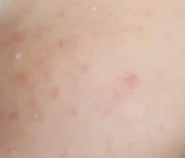 0 newborn baby with baby rash 1
